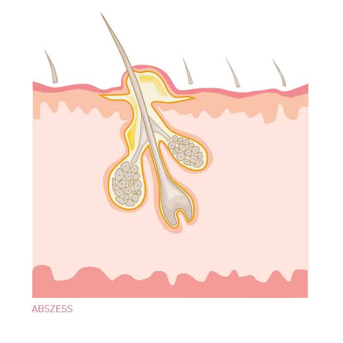 Abszess An Der Schamlippe Bilder