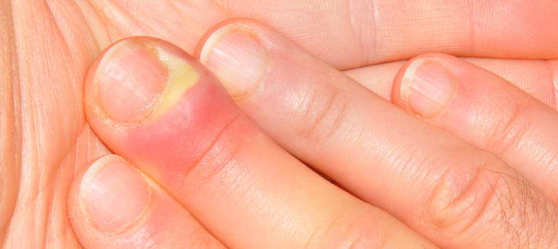 Finger nagelbettentzündung wildes fleisch Nagelentzündung »